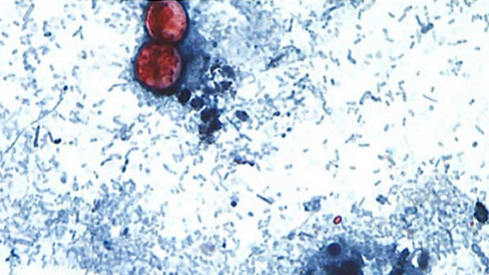 More than 24,000 cyclosporiasis infections reported as new cases appear to slow: CDC